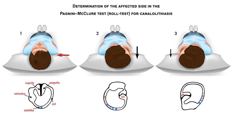 Horizontal Canal BPPV: Diagnosis and Treatment