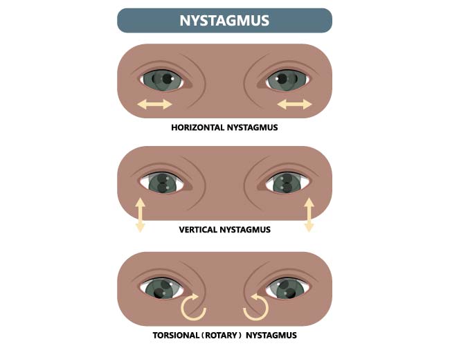 Nystagmus Test Vestibular First Telah Menambah Foto Baru Vestibular nystagmus-test-vestibular-first-telah-menambah-foto-baru-vestibular