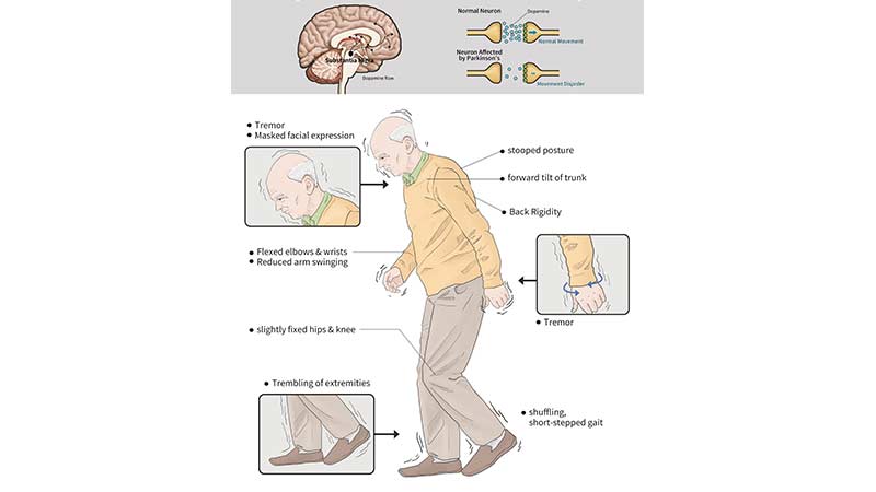 Parkinson’s disease symptoms