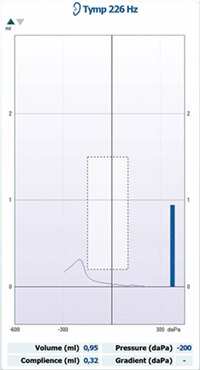 Understanding Tympanometry: A Comprehensive Guide
