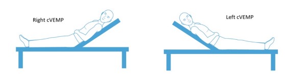 Cvemp Example Vestibular Evoked Myogenic Potentials (VEMP) | Testing Guides