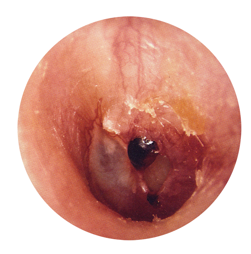 traumatic-perforation