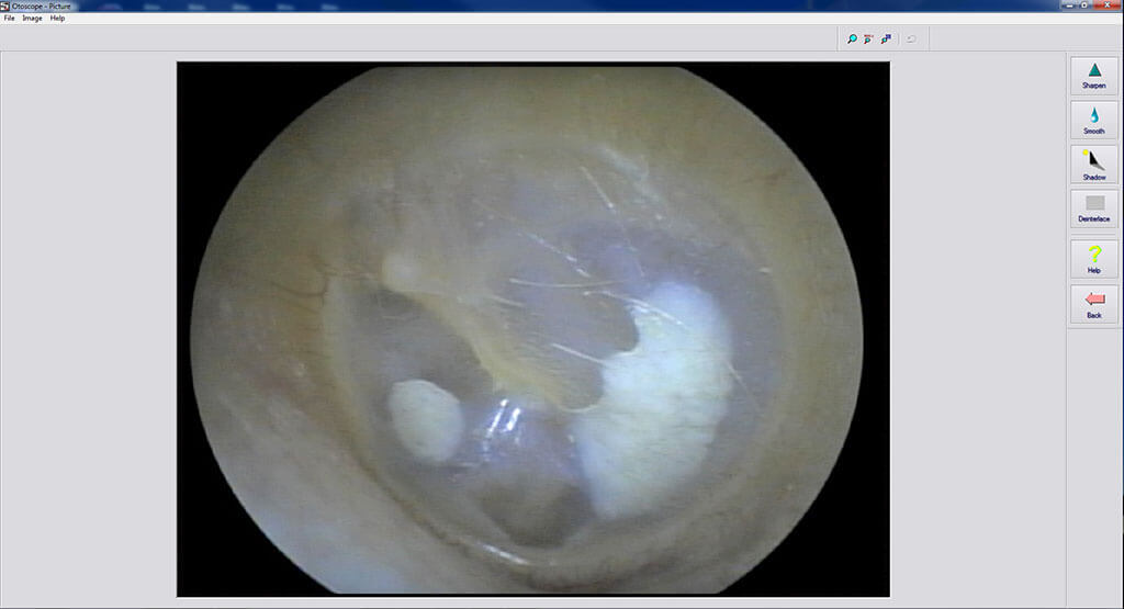 Video Otoscopy